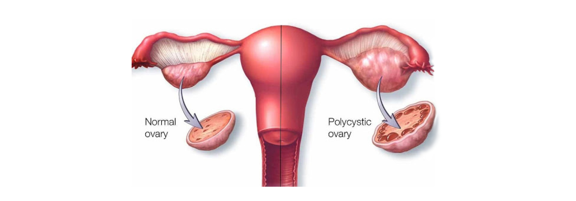 Treatment of Uterine Fibroids & Polycystic Ovarian Disease (PCOD)