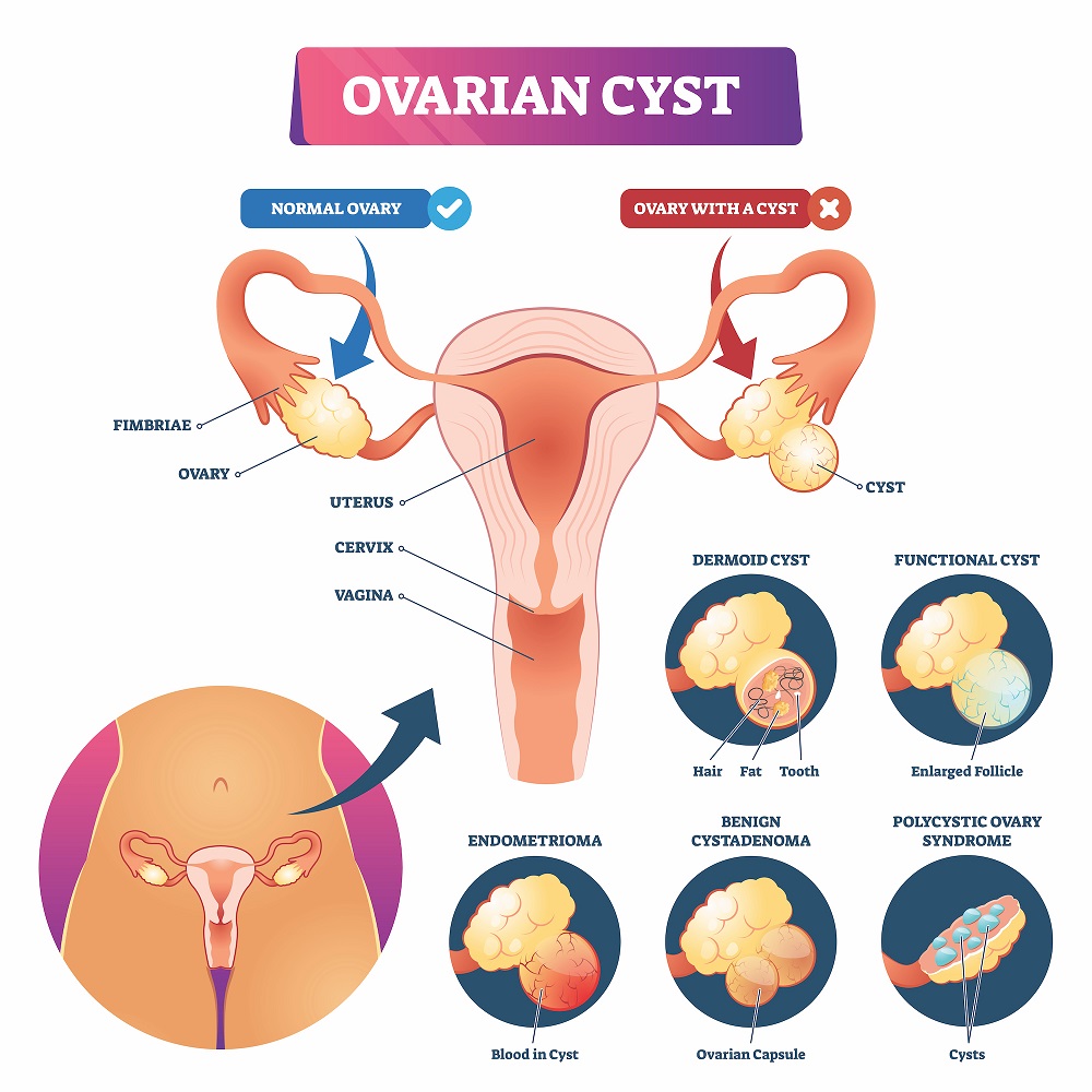 Homeopathy treatement for Ovarian cysts , ovary pain