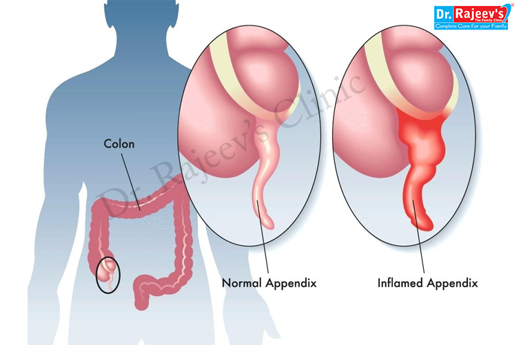 Homeopathy treatment for Appendicitis - Active Homoeopathy Kalyan